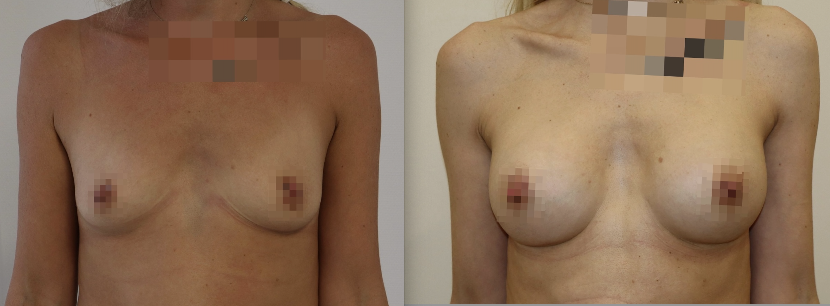 Avant/Après prothèses mammaires